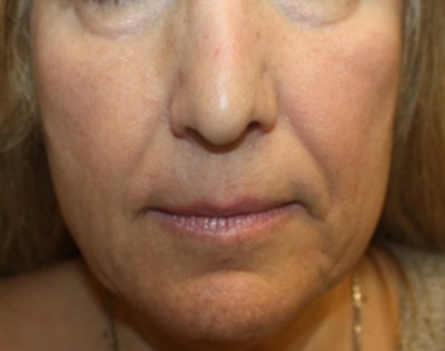 Injectable Fillers Before & After Patient #21360
