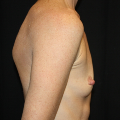 Breast Augmentation - Shaped Silicone Implants Before & After Patient #20518