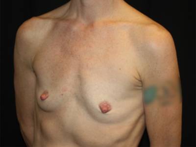 Breast Augmentation - Shaped Silicone Implants Before & After Patient #20518