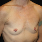 Breast Augmentation - Shaped Silicone Implants Before & After Patient #20518