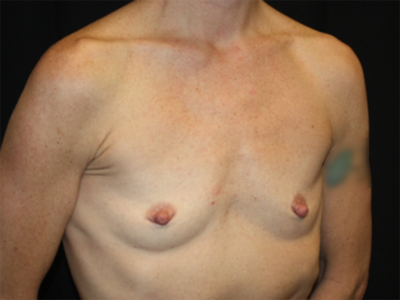 Breast Augmentation - Shaped Silicone Implants Before & After Patient #20518