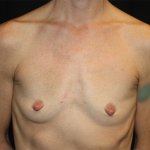 Breast Augmentation - Shaped Silicone Implants Before & After Patient #20518