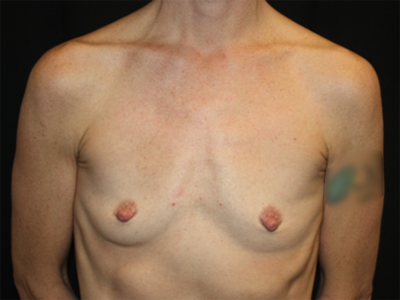 Breast Augmentation - Shaped Silicone Implants Before & After Patient #20518