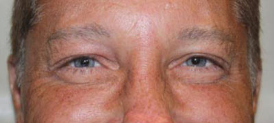Botox and Dysport Before & After Patient #20123