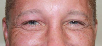 Botox and Dysport Before & After Patient #20123