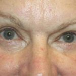 Blepharoplasty Before & After Patient #20196