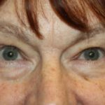 Blepharoplasty Before & After Patient #20196