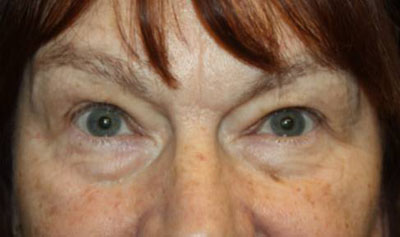 Blepharoplasty Before & After Patient #20196