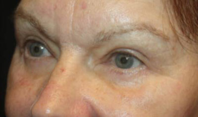 Blepharoplasty Before & After Patient #20196