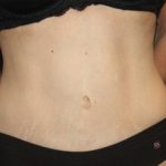 Tummy Tuck Before & After Patient #22586