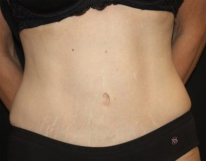 Tummy Tuck Before & After Patient #22586