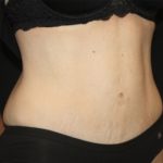 Tummy Tuck Before & After Patient #22586
