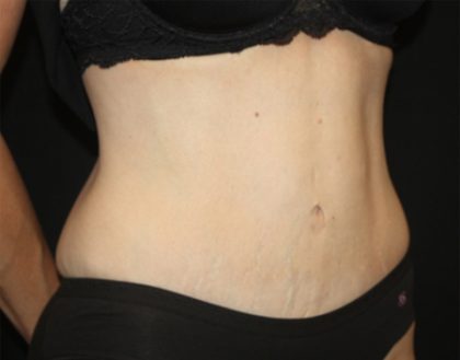 Tummy Tuck Before & After Patient #22586