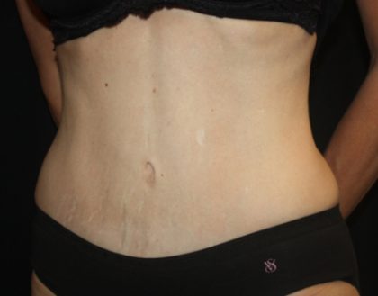 Tummy Tuck Before & After Patient #22586