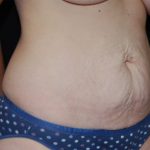 Tummy Tuck Before & After Patient #22586