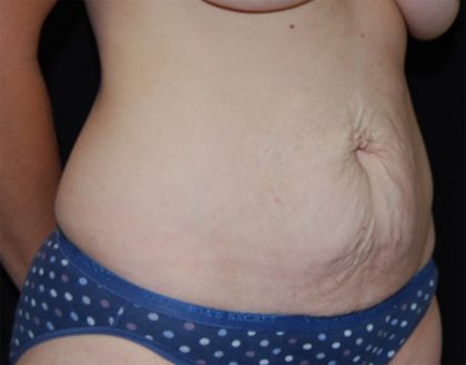 Tummy Tuck Before & After Patient #22586