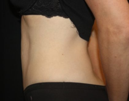 Tummy Tuck Before & After Patient #22586