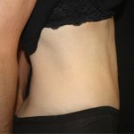 Tummy Tuck Before & After Patient #22586