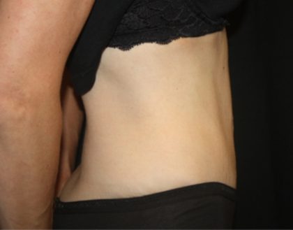 Tummy Tuck Before & After Patient #22586