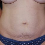 Tummy Tuck Before & After Patient #22586