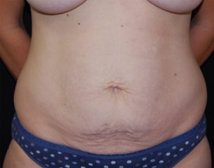 Tummy Tuck Before & After Patient #22586