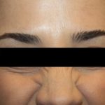 Botox and Dysport Before & After Patient #24695