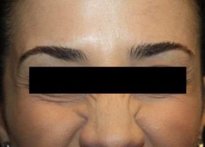 Botox and Dysport Before & After Patient #24695