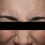 Botox and Dysport Before & After Patient #24695