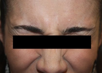 Botox and Dysport Before & After Patient #24695