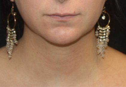 Liposuction Before & After Patient #21441