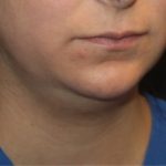 Liposuction Before & After Patient #21441