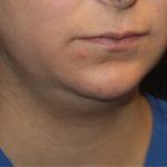 Liposuction Before & After Patient #21441