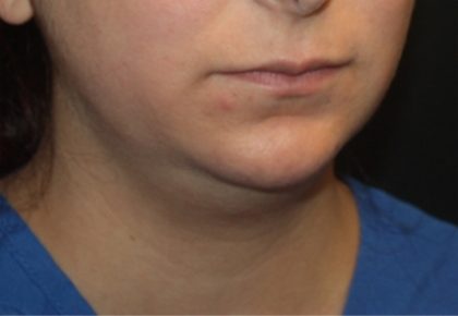 Liposuction Before & After Patient #21441