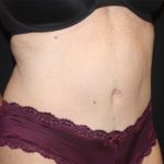 Tummy Tuck Before & After Patient #22598