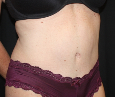 Tummy Tuck Before & After Patient #22598