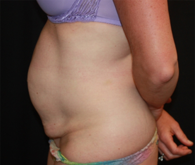 Tummy Tuck Before & After Patient #22598