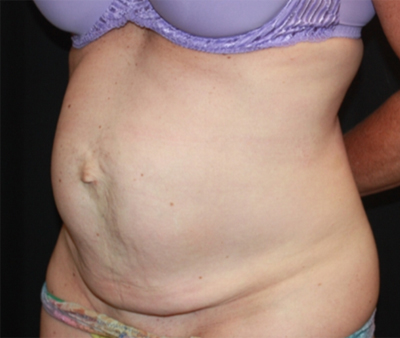 Tummy Tuck Before & After Patient #22598