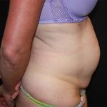 Tummy Tuck Before & After Patient #22598
