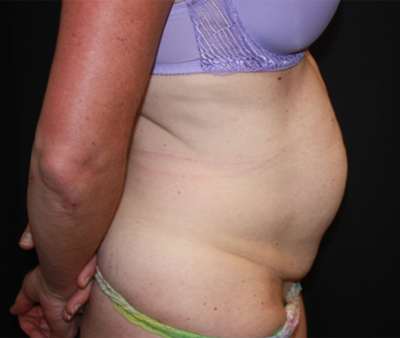 Tummy Tuck Before & After Patient #22598