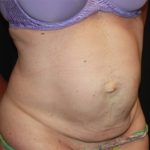 Tummy Tuck Before & After Patient #22598