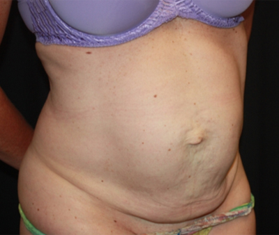 Tummy Tuck Before & After Patient #22598