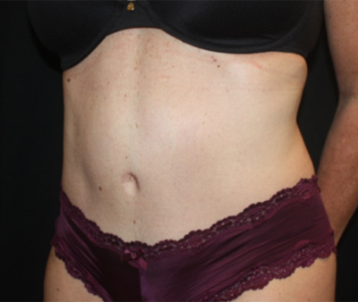 Tummy Tuck Before & After Patient #22598