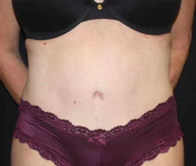 Tummy Tuck Before & After Patient #22598