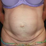 Tummy Tuck Before & After Patient #22598