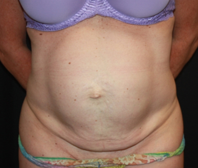 Tummy Tuck Before & After Patient #22598