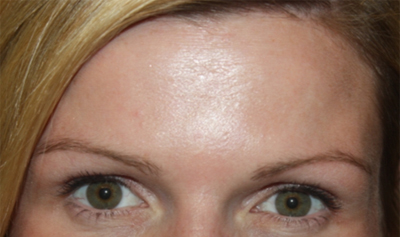 Botox and Dysport Before & After Patient #24705