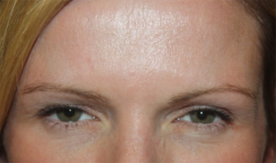 Botox and Dysport Before & After Patient #24705