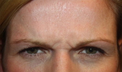 Botox and Dysport Before & After Patient #24705