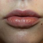 Injectable Fillers Before & After Patient #21359