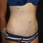 Tummy Tuck Before & After Patient #22609